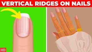 What Causes Vertical Ridges On Nails And How To Treat Them