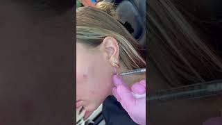 Creating a snatched jawline with Juvederm!