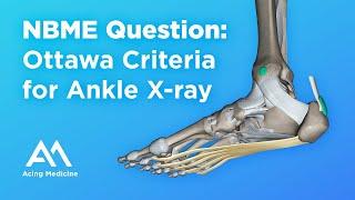 NBME Family Medicine Question: Ottawa Criteria for Ankle X-ray | Acing Medicine