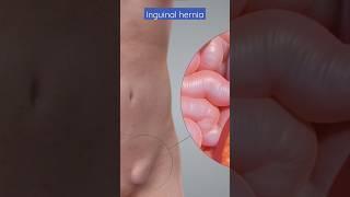 Inguinal hernia I Inguinal hernia treatment in Delhi @DrAshishSachan