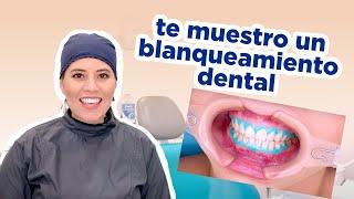 BLANQUEAMIENTO DENTAL / COMO LO HACEMOS