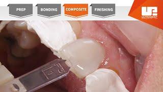 Composite | Your Complete Restorative Solution