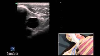 How To: Ultrasound Guided Insertion of a Subclavian Vein Catheter 3D Video