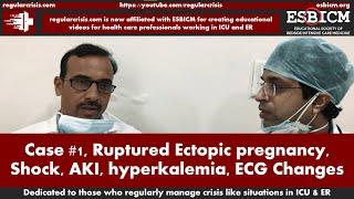 Case 1, RegularCrisis | Ruptured Ectopic pregnancy, Shock, AKI, hyperkalaemia, ECG Changes