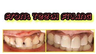Front teeth filling by composite ( TEETH SMILE RESTORATION )