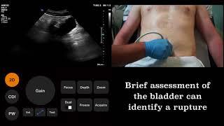 Ultrasound Tutorial: FAST (Focused Assessment with Sonography for Trauma) scan | Radiology Nation