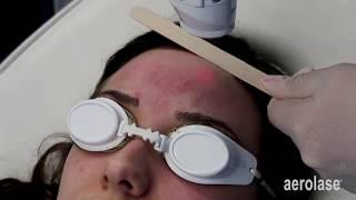 NeoClear Acne Treatment Testimonial