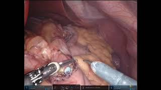 Robotic Gastric Bypass