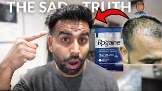 Does Rogaine Work? | My Biggest Regret 6 Years Later... ‍️