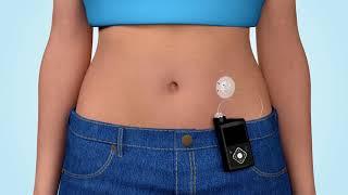 Что такое инсулиновая помпа?
