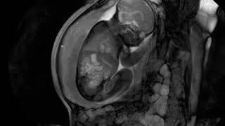 MRI scan at 32 weeks