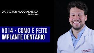 Como é feito o Implante Dentário | Dr. Victor Hugo Almeida