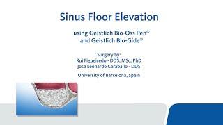 Sinus Floor Elevation using Geistlich Bio-Oss Pen® and Geistlich Bio-Gide®