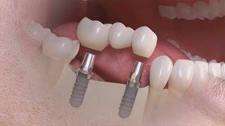 Straumann - Tratamento de vários dentes com solução implanto-suportada