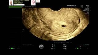 Early Pregnancy 5 weeks normal intrauterine (Dr Wiku Andonotopo)