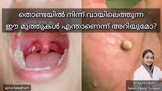 Tonsil stone | Tonsillolith health talk by Dr Ajina Salim