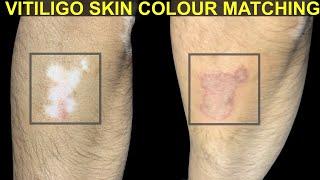 Vitiligo - Pathophysiology , skin depigmentation, causes & treatment