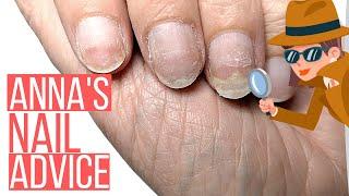 NAILS SEPARATING FROM NAIL BED!! ANNA HELP!!  [ANNA'S NAIL ADVICE]