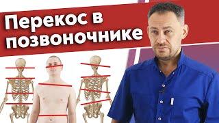 Что такое сколиоз позвоночника? / Какие последствия будут, если не лечить перекос позвоночника?