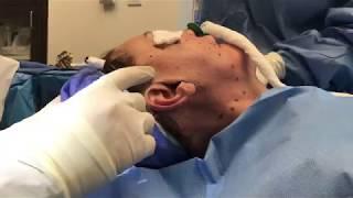 Facelift Incisions