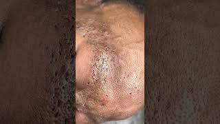 Part 2  Nevus Comedonicus