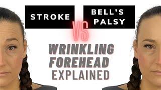 How to differentiate bell's palsy from stroke?