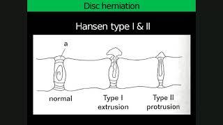 Spinal lecture 2 Degenerative