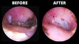 Infection and Ear Wax BEFORE AND AFTER Antibiotic Drops (9:28 Otomize)