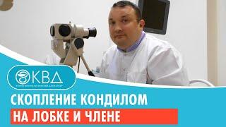  Скопление кондилом на лобке и члене. Клинический случай №752