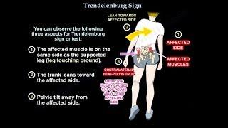 Trendelenburg Sign - Everything You Need To Know - Dr. Nabil Ebraheim