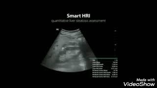 Resona i9 high resolution Ultrasound machine (Demo)