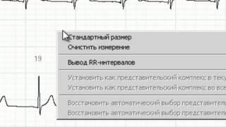 Анализ ЭКГ