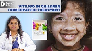 Vitiligo In Children Homeopathic Treatment | White Skin Patch - Dr. Vindoo C | Doctors' Circle