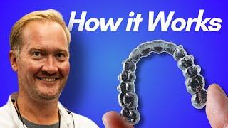 How Invisalign Works in 2024