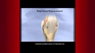 FOX Sports Keck Medicine of USC Report: Total Knee Replacement