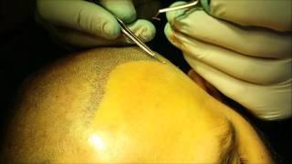 FUE Hair Transplant - Wimpole Clinic