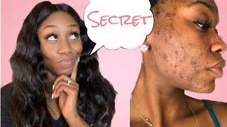 SKIN l Removing Hyperpigmentation (Dark Spot) Secret | Shanese Danae