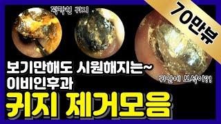 보기만해도 시원해지는 이비인후과 귀지 제거 모음 (Earwax Removal)