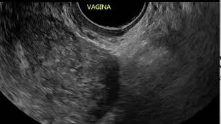 Video 5: Normal vagina