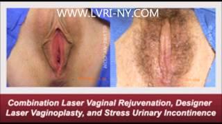 Laser Vaginal Rejuvenation with Stress Urinary Incontinence Before and After Photos | LVRI-NY