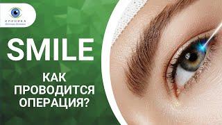 Смайл (ReLEx SMILE) - лазерная коррекция зрения. Видео операции.