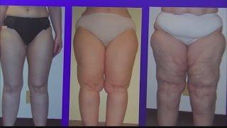 Lipedema: Women gaining weight at no fault of their own