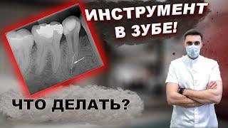 ИНСТРУМЕНТ В ЗУБЕ! Что делать? #стоматология #лечениезубов