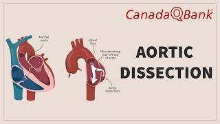 Aortic Dissection