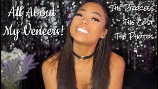 All About My Veneers!!!