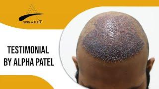 Patient testimonial | Mr Alpha Patel | Hair Transplant done by Dr. Alok Sahoo