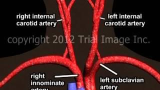 Aortic anatomy and disease (vasculopathy) video - Animation by Cal Shipley, M.D.