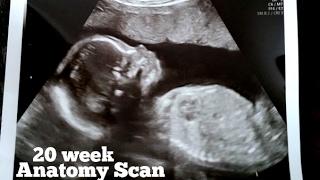 20 week Ultrasound: Anatomy Scan | Lani