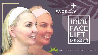 Mini facelift and neck lift using Inmode facetite device