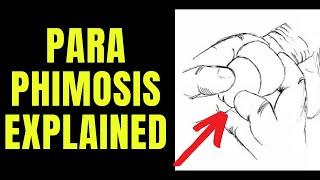 Doctor explains Paraphimosis - aka swollen foreskin that you can't pull back...